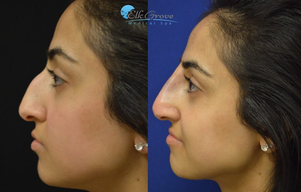 Rhinoplasty Costs Elk Grove California Rhinoplasty Costs Elk Grove California