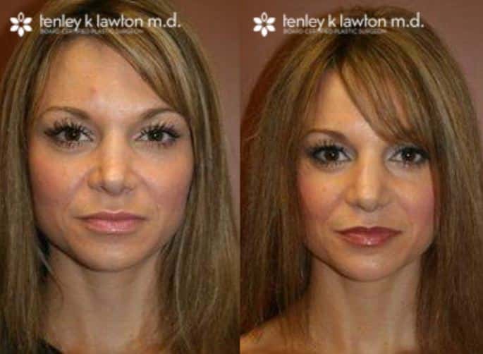 Rhinoplasty Costs Elk Grove California Rhinoplasty Costs Elk Grove California
