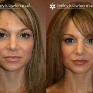 rhinoplasty costs elk grove california 6