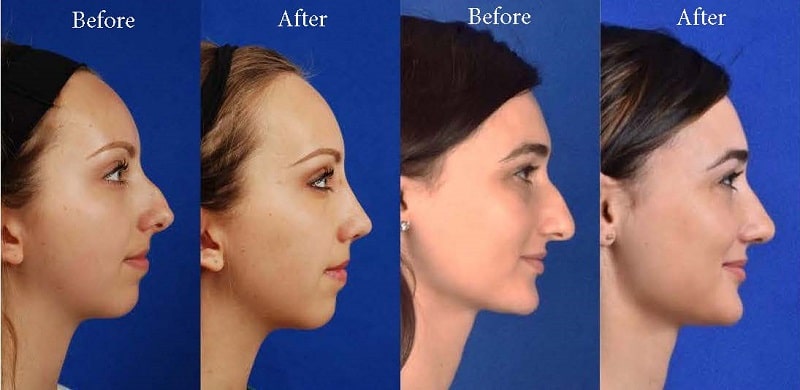 Rhinoplasty Costs Eugene Oregon