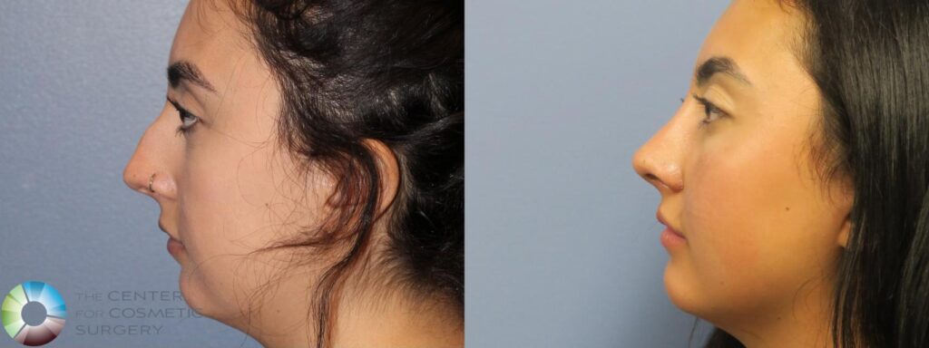 Rhinoplasty Costs Fort Collins Colorado