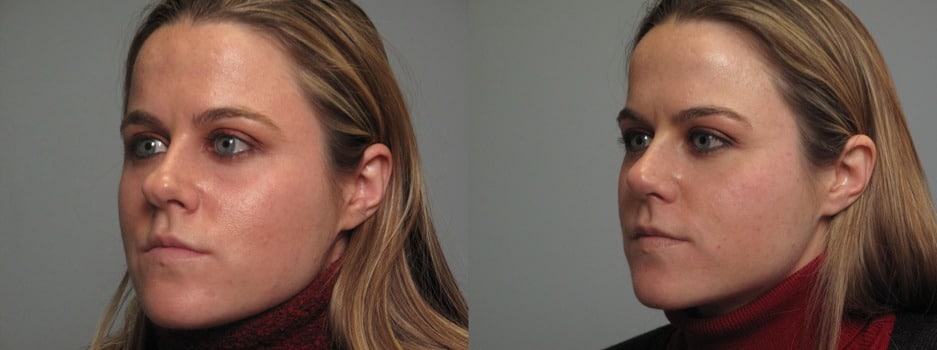 Rhinoplasty Costs Fort Collins Colorado
