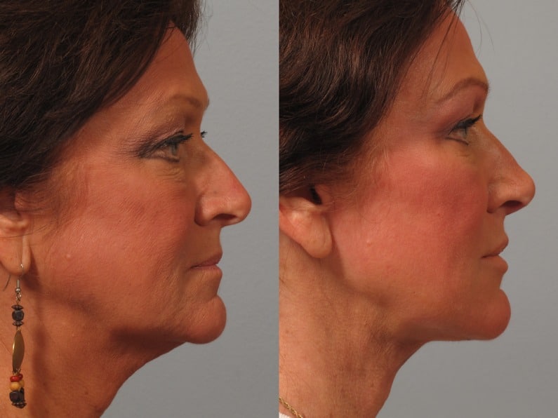 Rhinoplasty Costs Fort Collins Colorado