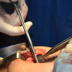 rhinoplasty costs glendale arizona 2