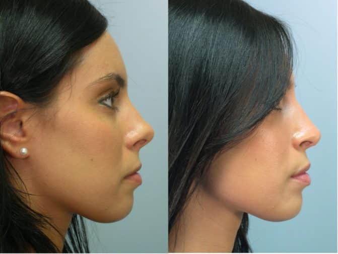 Rhinoplasty Costs Hampton Virginia