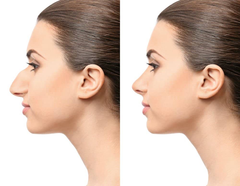 Rhinoplasty Costs Hampton Virginia