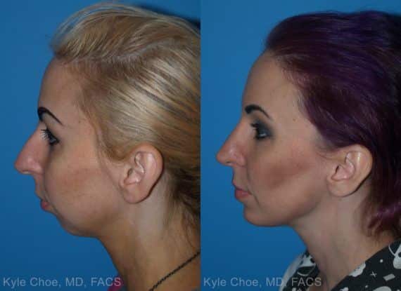 Rhinoplasty Costs Hampton Virginia