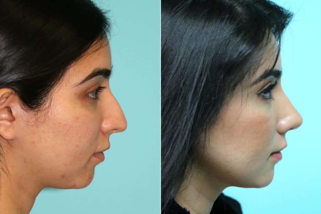 Rhinoplasty Costs Hampton Virginia