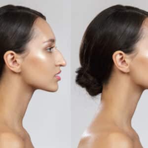 rhinoplasty costs hampton virginia 5