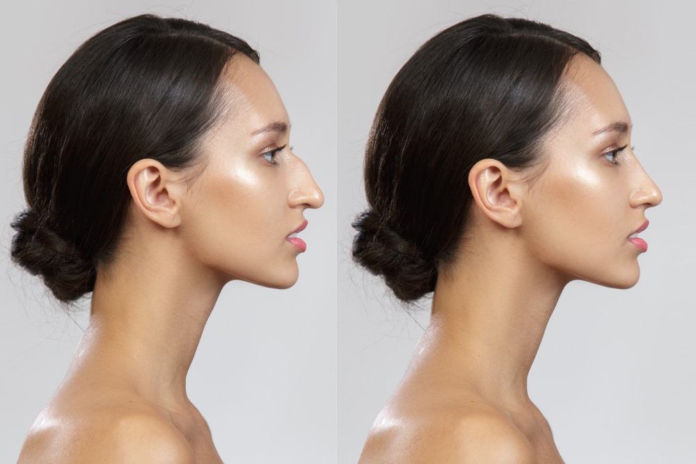 Rhinoplasty Costs Hampton Virginia