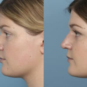 rhinoplasty costs joliet illinois 2