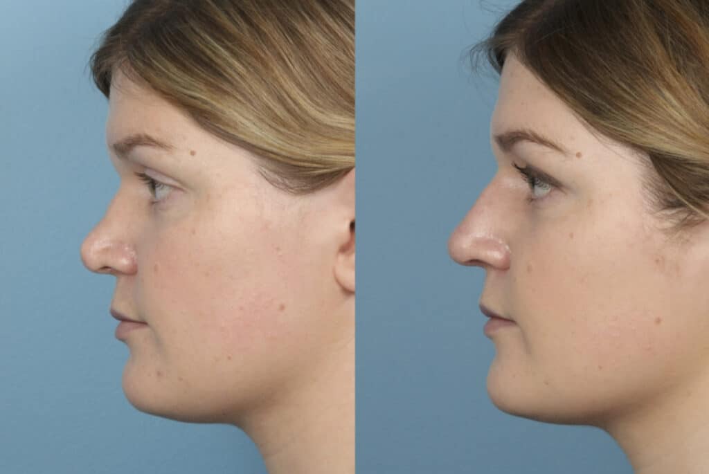 Rhinoplasty Costs Joliet Illinois