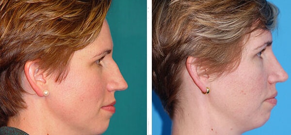 Rhinoplasty Costs Lakewood Colorado