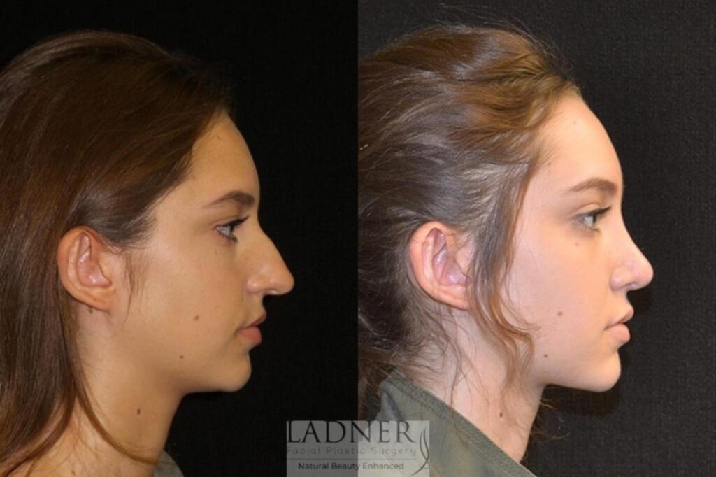 Rhinoplasty Costs Lakewood Colorado