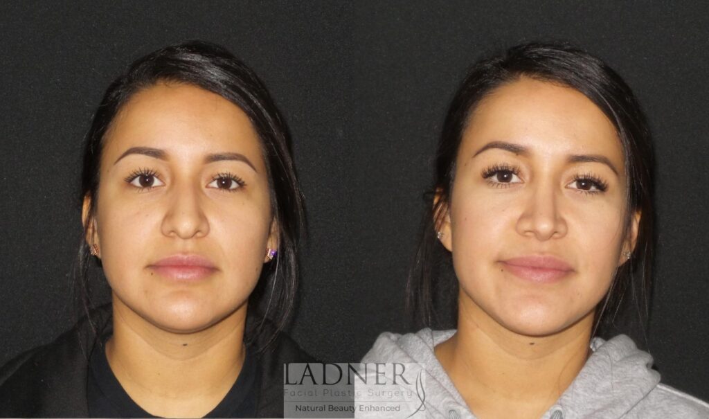 Rhinoplasty Costs Lakewood Colorado