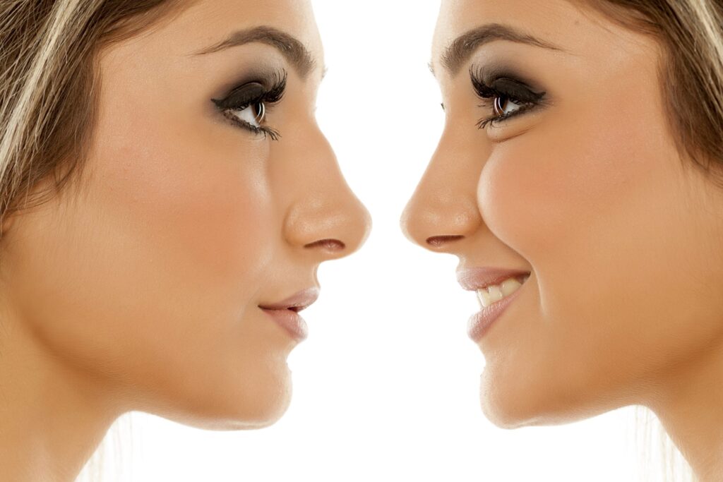 Rhinoplasty Costs Lakewood Colorado