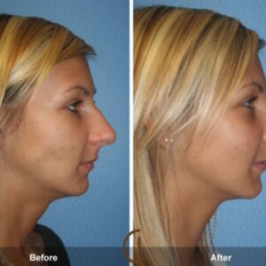 rhinoplasty costs lakewood colorado 6