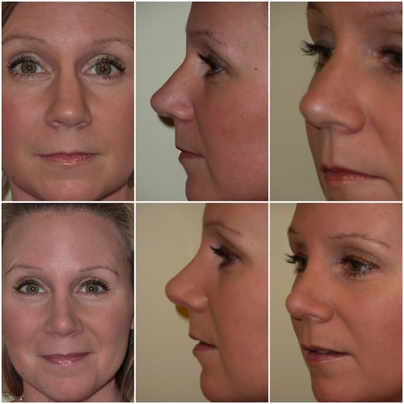 Rhinoplasty Costs Manchester New Hampshire