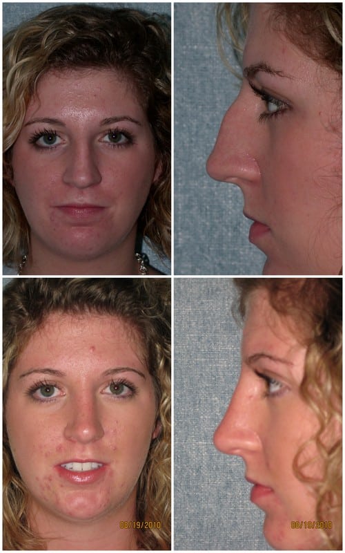 Rhinoplasty Costs Manchester New Hampshire