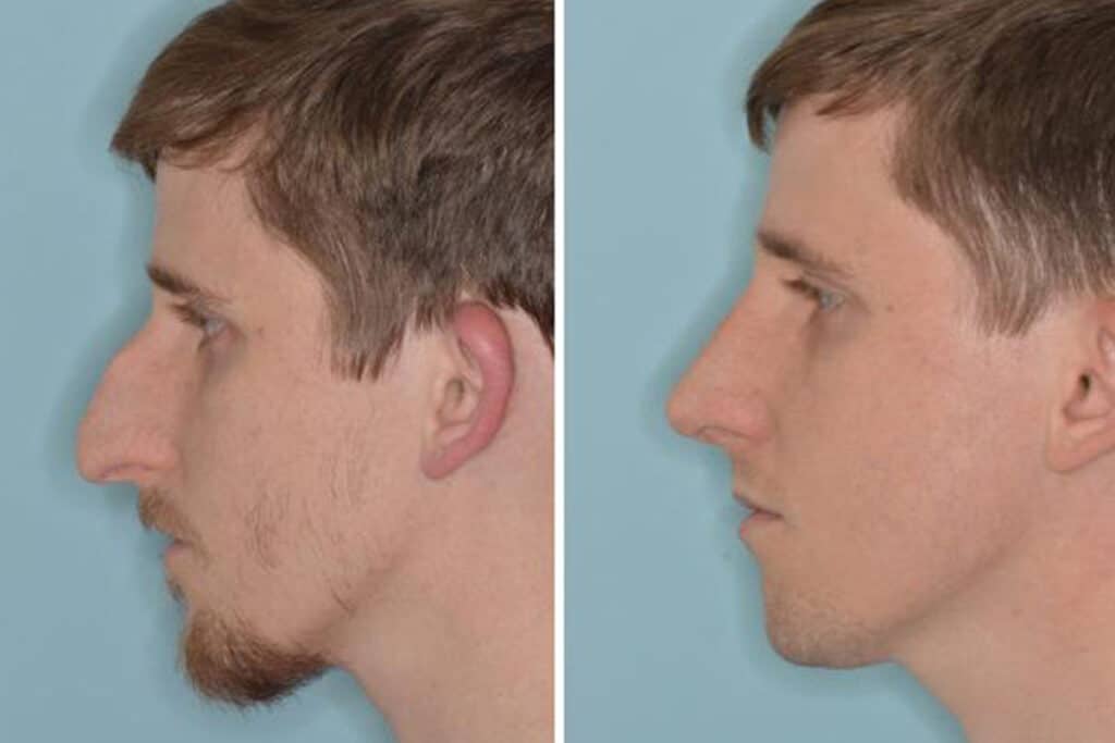 Rhinoplasty Costs Miami Gardens Florida