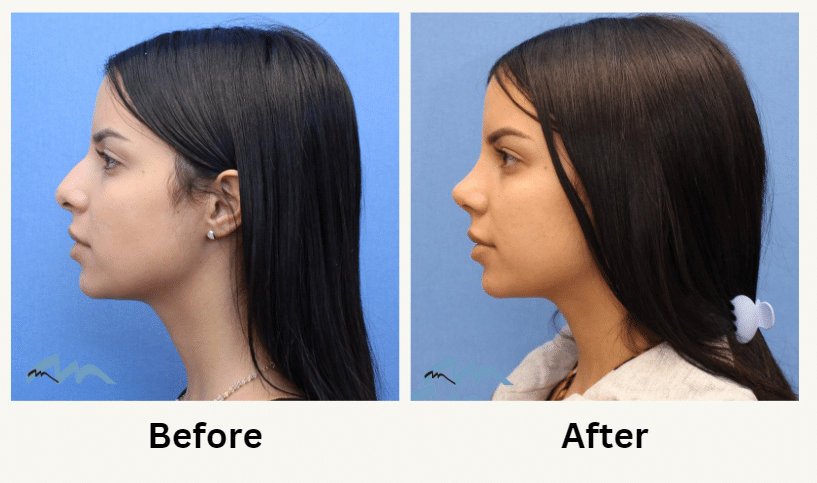 Rhinoplasty Costs Miami Gardens Florida