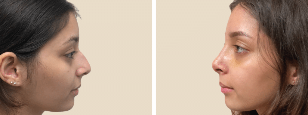 Rhinoplasty Costs Miami Gardens Florida