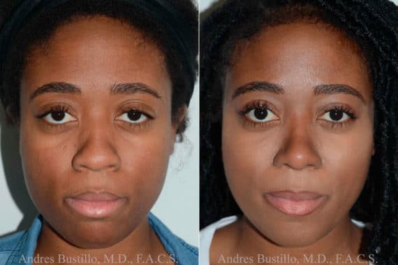 Rhinoplasty Costs Miami Gardens Florida