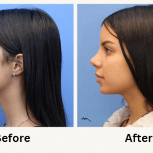 rhinoplasty costs miami gardens florida 3