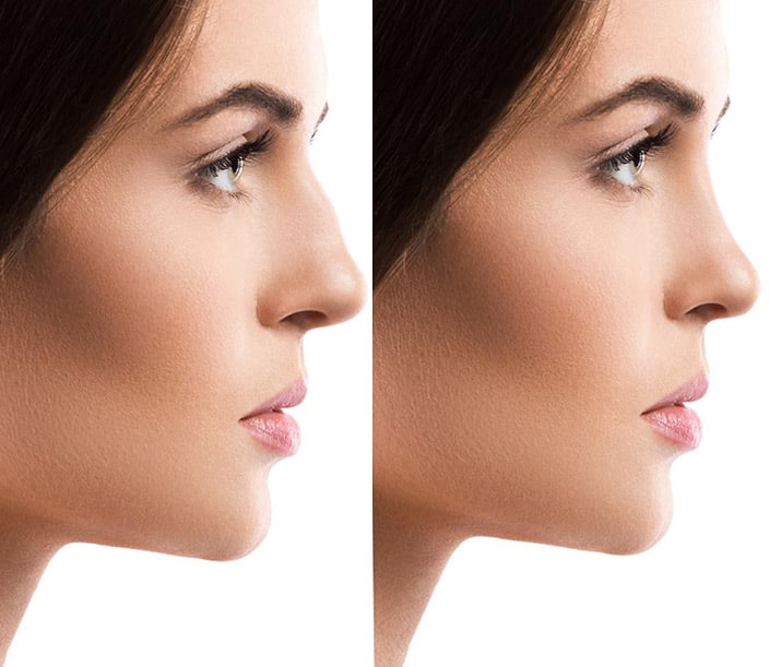 Rhinoplasty Costs Miami Gardens Florida