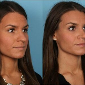rhinoplasty costs naperville illinois 1