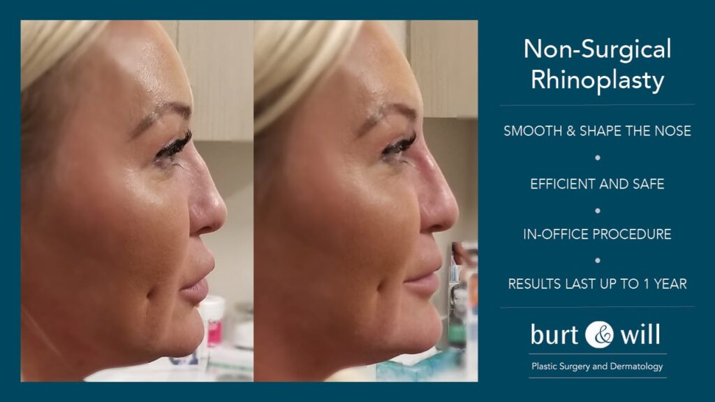 Rhinoplasty Costs Naperville Illinois