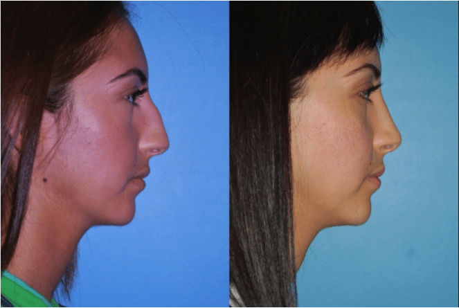 Rhinoplasty Costs Naperville Illinois