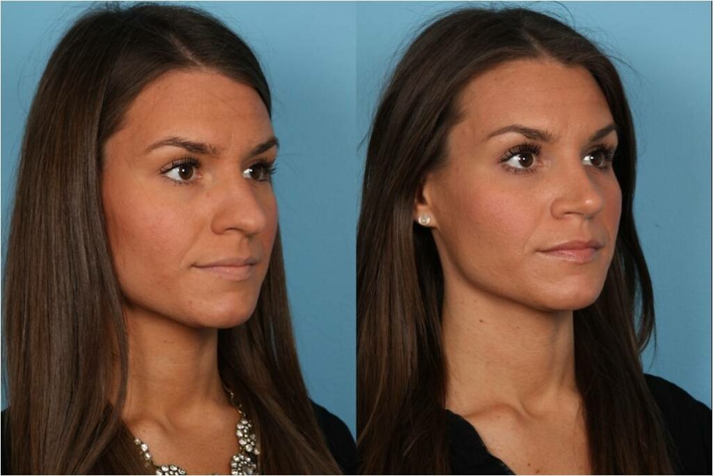 Rhinoplasty Costs Naperville Illinois