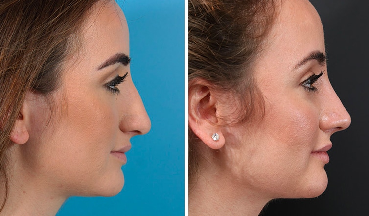 Rhinoplasty Costs Ontario California Rhinoplasty Costs Ontario California