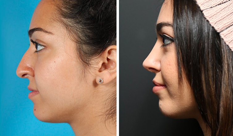 Rhinoplasty Costs Ontario California Rhinoplasty Costs Ontario California