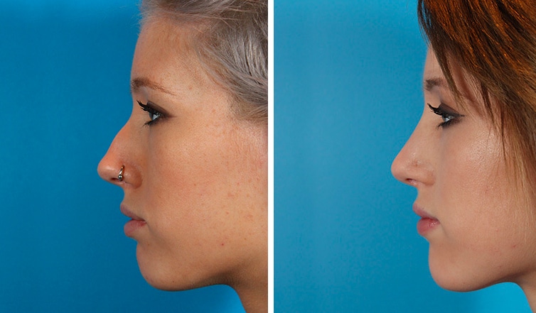 Rhinoplasty Costs Ontario California Rhinoplasty Costs Ontario California