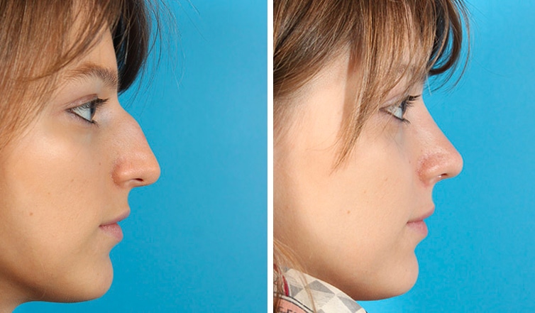 Rhinoplasty Costs Ontario California Rhinoplasty Costs Ontario California
