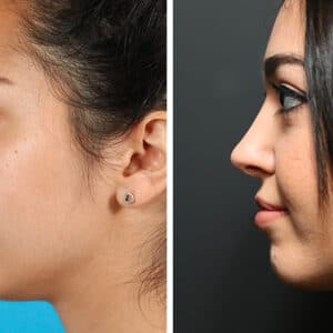 rhinoplasty costs ontario california 5