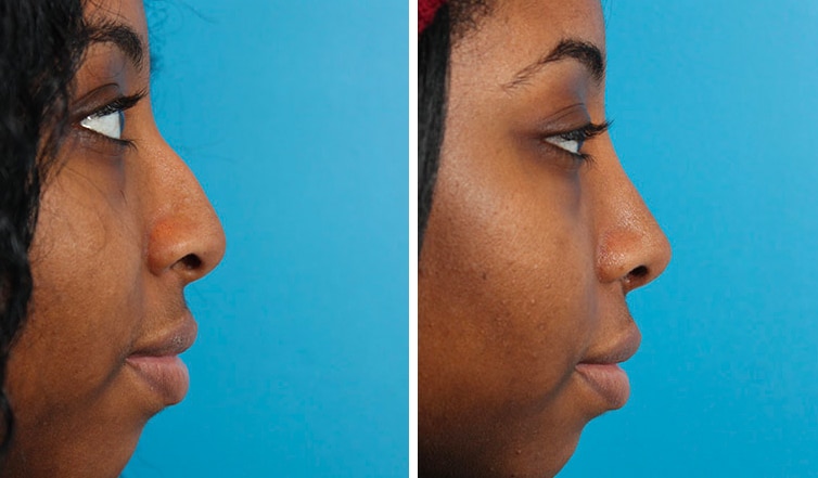 Rhinoplasty Costs Ontario California Rhinoplasty Costs Ontario California