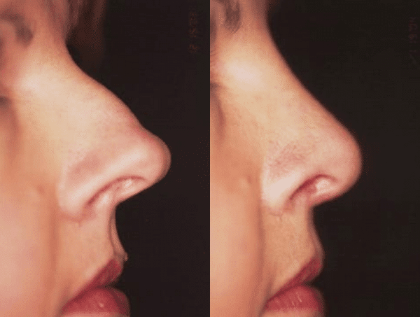 Rhinoplasty Costs Orlando Florida