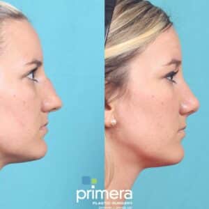 rhinoplasty costs orlando florida 3
