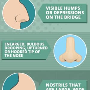 rhinoplasty costs overland park kansas 4