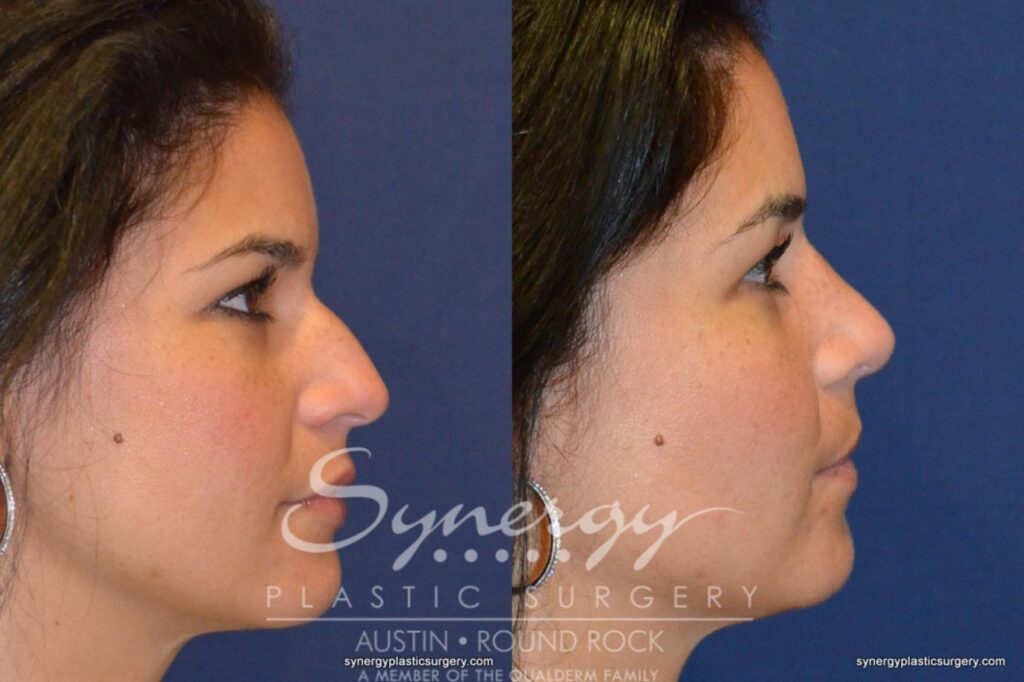 Rhinoplasty Costs Round Rock Texas
