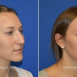 rhinoplasty costs round rock texas 2