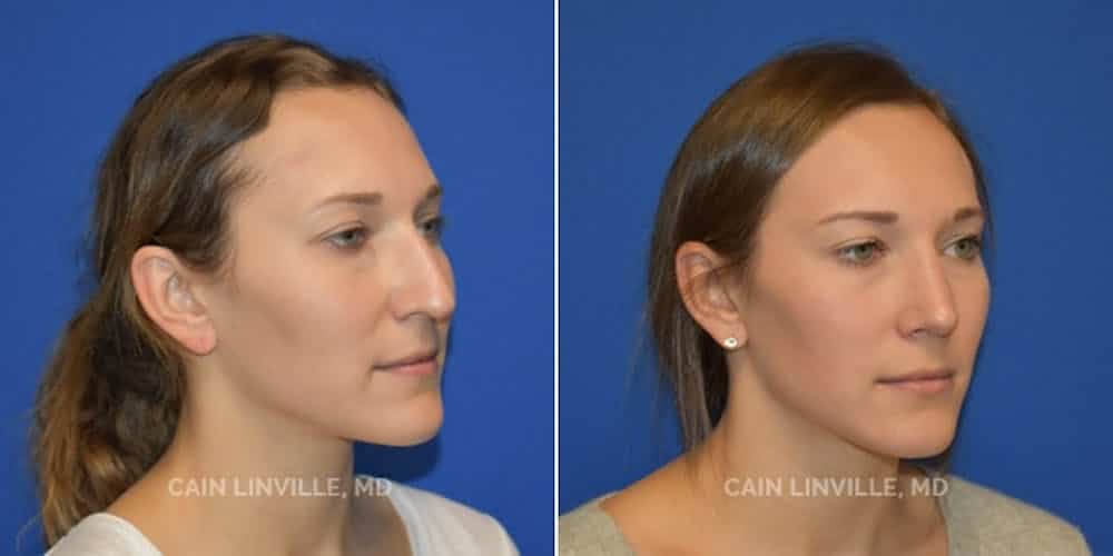 Rhinoplasty Costs Round Rock Texas