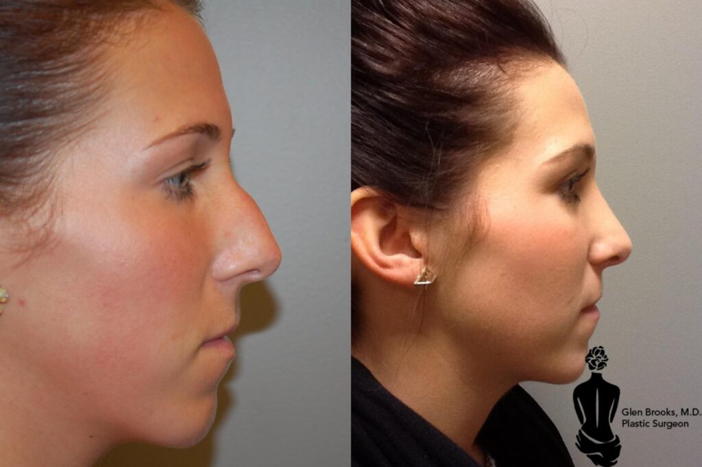 Rhinoplasty Costs Springfield Massachusetts