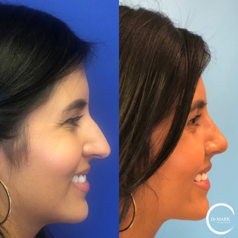 Rhinoplasty Costs Springfield Massachusetts