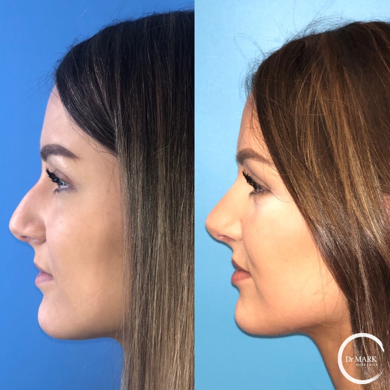 Rhinoplasty Costs Springfield Massachusetts