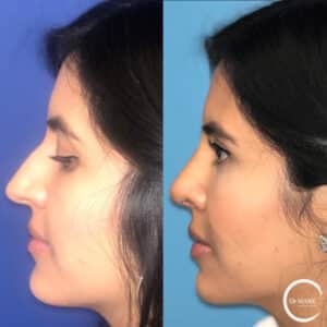 rhinoplasty costs springfield massachusetts 4