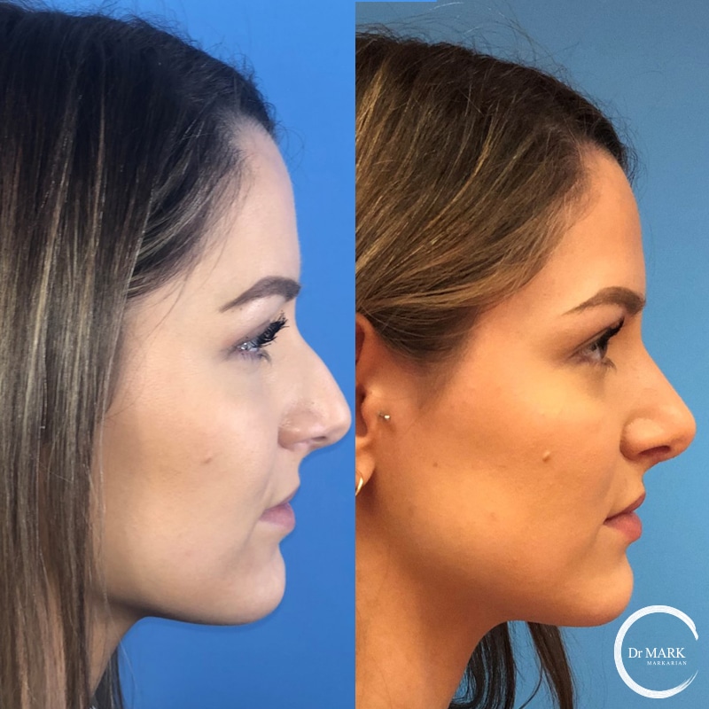 Rhinoplasty Costs Springfield Massachusetts